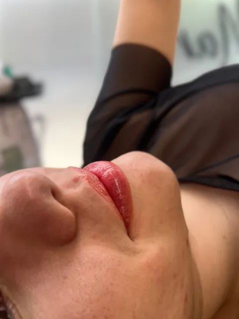 Revitalização Labial: foto 1 de atendimento